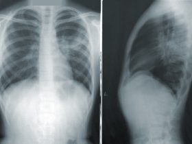 Akciğer röntgeni