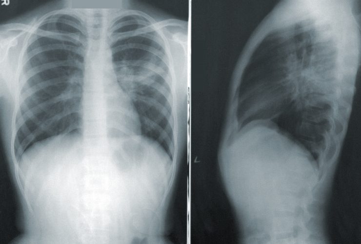 Akciğer röntgeni
