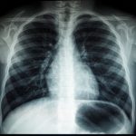 Akciğer grafisi