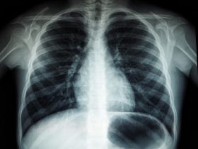 Akciğer grafisi