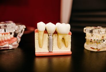 Diş implantı