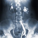 Üriner sistem röntgeni